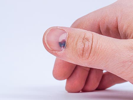 Damaged nail bed pictures best sale